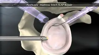 PushLock Mattress 360 552WM