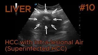 Liver &ndash; Hepatocellular Carcinoma with Intra-lesional Air (Superinfected HCC) &ndash; Clip 1 B-mode