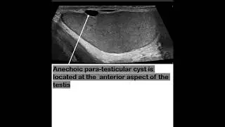 Tunica Albuginea cyst