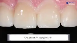 bộ kit gắn d&aacute;n đa năng eCement của Bisco - Mỹ