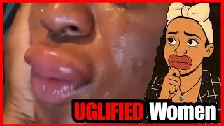 Botched Lip Filler.. Another UGLY Trend Making Women UGLY