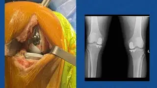 Mako Robotic Assisted Partial Knee resurfacing
