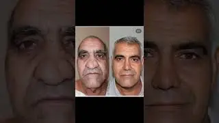 @AsmsMedical   The ultimate face surgery?