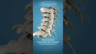 Back Pain from Degenerative Disc Disease?