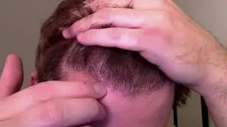Third Procedure: 7 months post-op (8-27-17)