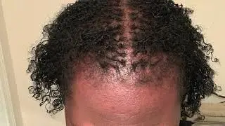 23 month Sisterlocks&copy; Hair Growth Timelapse on Fine Thin Hair Low Density Crown
