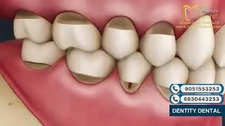 Dental Abrasions Explained | Causes, Symptoms & Treatment | Dentity Dental