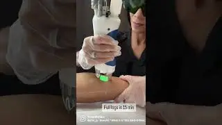 Laser hair removal on full legs in 15 minutes with the Splendor X by Lumenis #hairremovallaser