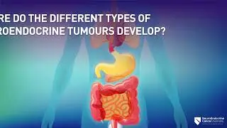 Symptoms Types and Diagnosis of Neuroendocrine Tumours (NETs)