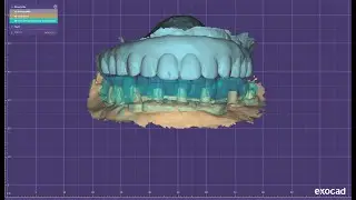 How to merge preop scan and implant scan in Exocad ?