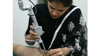 Co2 laser skin resurfacing | Scar treatment | Dr. Priyanka Reddy | DNA Skin Clinic |