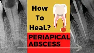 Case of PERIAPICAL ABSCESS| Dr. Sunil kumar| Dental ji