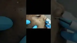 Electrocautery Procedure - Skin Tags Removal