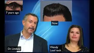 Great hairline repair by Dr. Lindsey hair transplantation in Washington | McLean | Virginia | DC