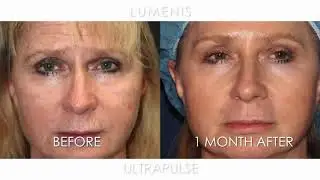 Dr. Daniel Friedmann is Using UltraPulse ActiveFX (Korean Subtitles)