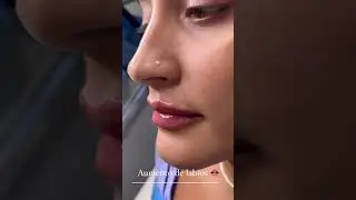 Aumento de labios con &aacute;cido hialur&oacute;nico
