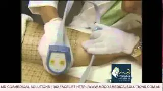 Sydney Thermage Treatment for Cellulite