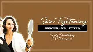 Skin Tightening and Collagen Renewal Treatments | Simply Dermatology | Dr Kally Papantoniou