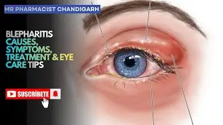 Blepharitis | Causes, Symptoms, Treatment & Eye Care Tips full information 2026