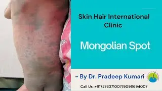 Mongolian Spot
