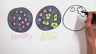 Carbone Classroom: How Pathologists Identify Cancer
