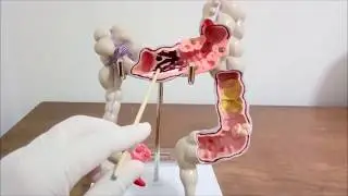 Patologias do Intestino Grosso- #doen&ccedil;asdointestino