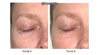 City Beauty Lid Lifting Treatment Review: Does It Really Tighten Hooded Eyelids?
