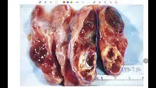 Special pathology OSPE upto 2025. Endocrinology 