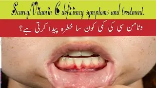 vitamin C deficiency symptoms. Scurvy in detail (symptoms +diagnosis +Treatment)