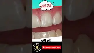 #dentistryknowledge#dentist#world#tooth#bridge#restoration#smile#shorts#youtube#viral#top#instagram#
