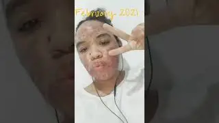 My journey with acne fulminans :)
