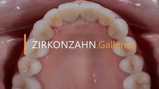 Complete upper restoration with single crowns | Zirkonzahn.Galleries