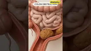 Colon Obstruction Explained in 3D  Probiotic Pixels  #digestivehealth #3danimation