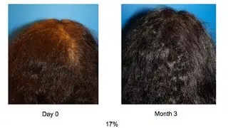 Amazing Hair Regrowth!!! ACell + Platelet Rich Plasma (PRP) - 2017 Video and Photos