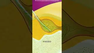 Pilonidal cyst treatment 3D animation #drone #theflash #space #automobile #scifi #spaceracer