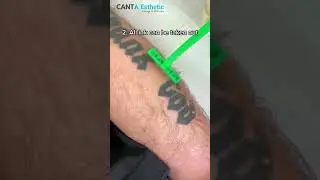 laser tattoo removal machine to safely and efficiently