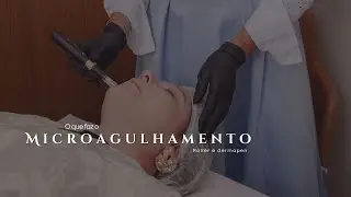 COMO O #MICROAGULHAMENTO AGE NA #PELE #estetica