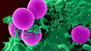 7 Important Signs of Leukemia You Shouldn&rsquo;t Ignore - Health and life