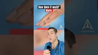 THIS is how warts work