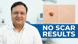 Big Mole Removal Without Scar | Laser Mole Removal Results Punjab