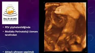 Pes Ekinovarus - Doğumsal Çarpık Ayak l Doç.Dr. Ali Ekiz
