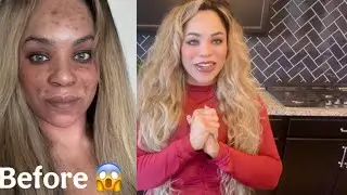 How I Got Rid Of My Post Inflammatory Hyperpigmentation Fast! Ft. Hishowru