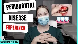 Periodontal Disease and the Pockets Explained