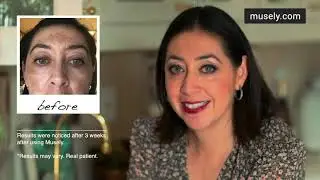 How To Treat Stubborn Melasma with Prescription Skincare (Claudia's Story) | Musely FaceRx