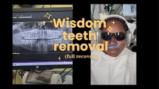 Getting My Wisdom Teeth Removed | Full Recovery!! | Vlog |