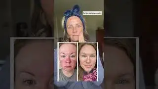 Inflammation looks like this