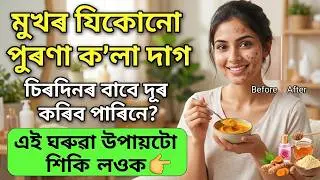 মুখৰ যিকোনো পুৰণা ক’লা দাগ চিৰদিনৰ বাবে দূৰ হ’ব | এই ঘৰুৱা উপায়টো শিকি লওক | Home Remedies