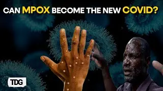 WHO: Mpox Has Different Transmission and Impact than COVID-19