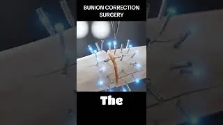 Bunion Correction Surgery Explained | 3D Animation | Foot Surgery
