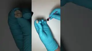 Is Silver Diamine Fluoride Replacing Sealants?